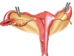 Laqueação de Trompas